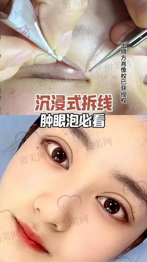 口碑爆棚：谢立宁眼修复的“魔法魅力”