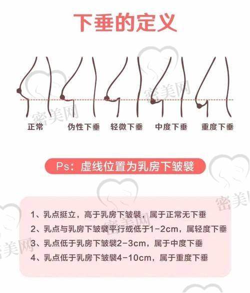 玻尿酸丰胸的注意事项