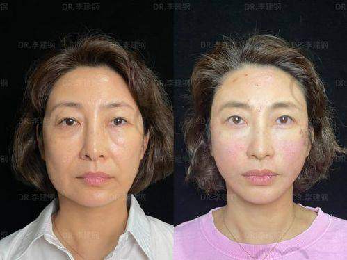 北京华韩整形医院虞守辉皇冠线打造：真人实例见证奇迹