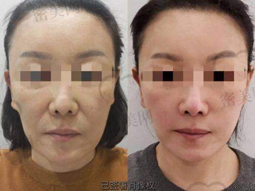 揭秘上海华美李志海颧骨内推成效，这是真“香”还是“雷”？