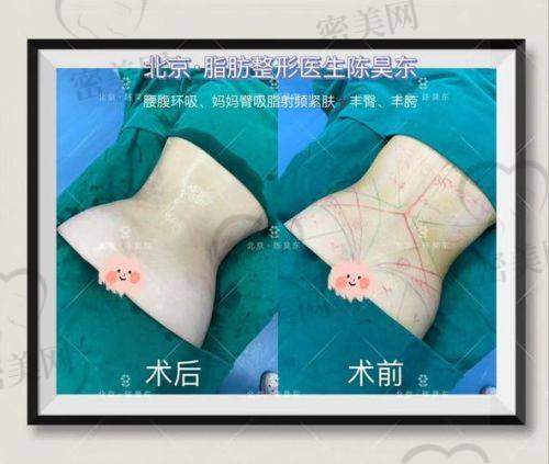 北京华韩整形医院：吸脂的强大后盾