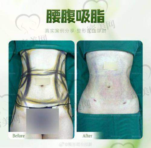 腰腹吸脂手术：紧张又期待