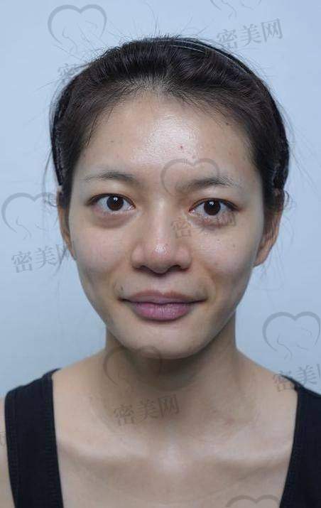 填充成效能维持多久？