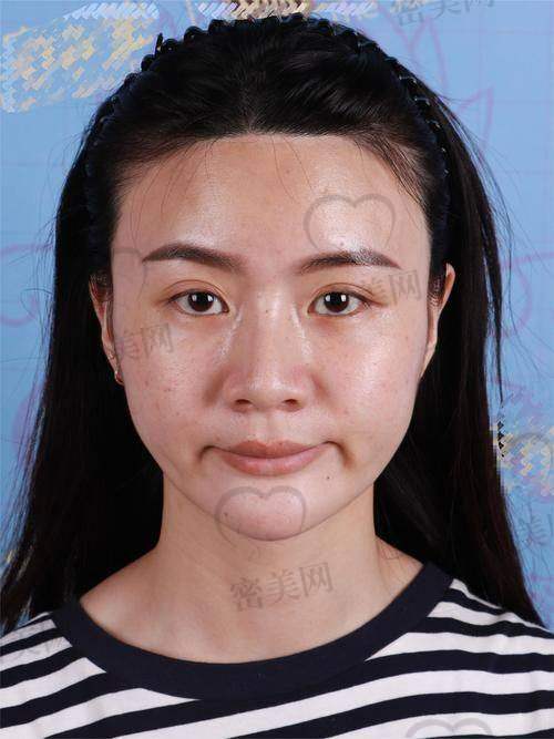 脸部凹陷用什么填充更好？