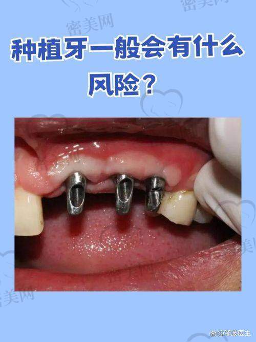 沈阳牙元素口腔医院的种植牙多少钱？价格表看这里