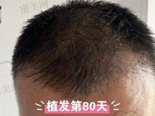 万州丝粟植发中 心：专注微针无痕，轻松跨越秃烦恼