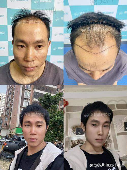 重庆万州新生植发医院：技术体系全方面，标准化严谨