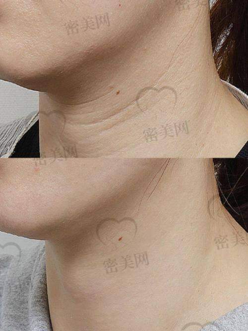 嗨体与肉毒素、玻尿酸谁更优？