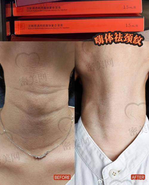嗨体1.5和2.5有何区别？