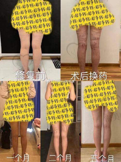杨超医生的技术特色：精细又效率高