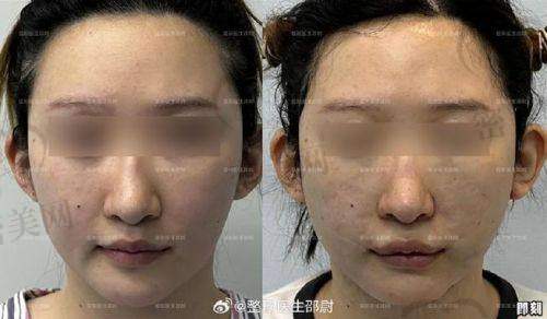 术后修复：惊喜不断