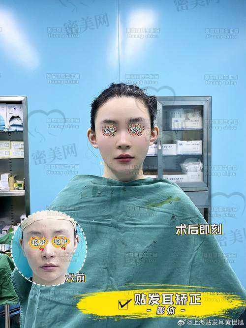 北京华韩虞守辉：3 万起的耳基底精细化注射，性价比逆天啦！