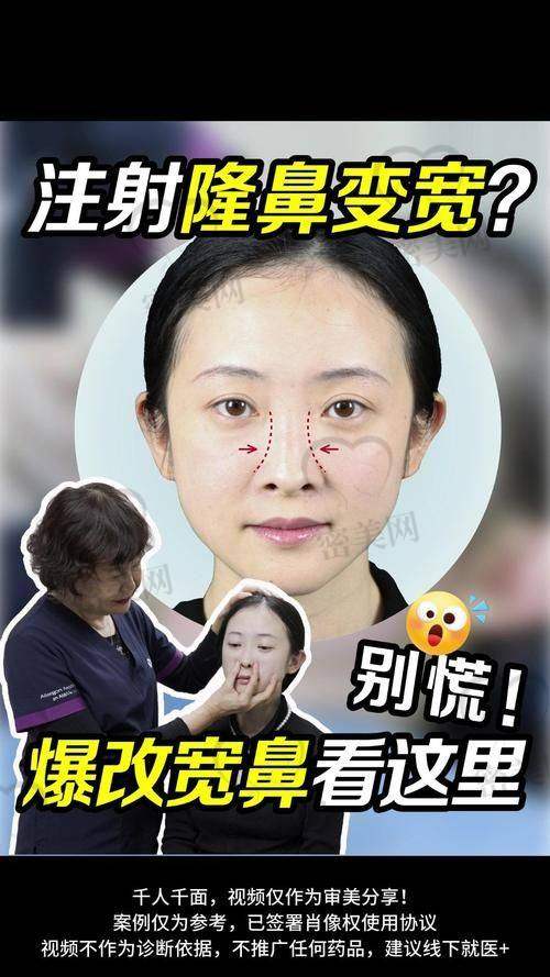 鼻子打玻尿酸能维持多久？