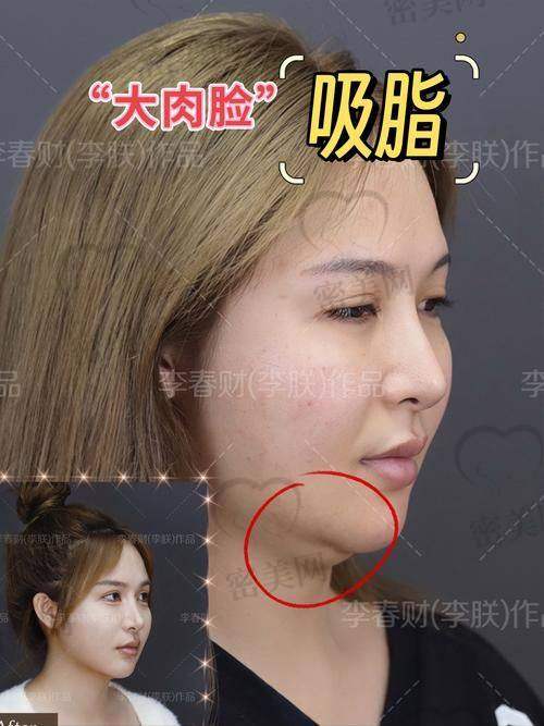 惊艳成效：杨超医生不带头套面部吸脂的魅力