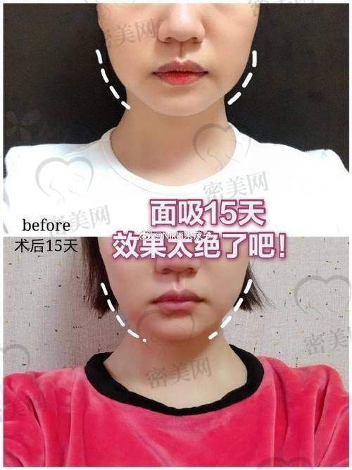 手术过程：杨超医生的不错技术