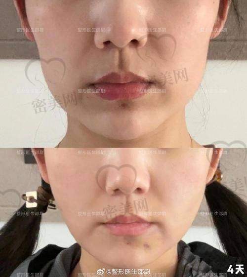 术后修复：不带头套的轻松体验
