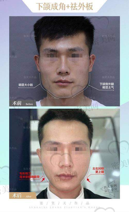 李志海削骨价格多少？这可是大家关心的“钱袋子”问题