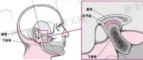 上海华美李志海颧骨内推成效惊艳