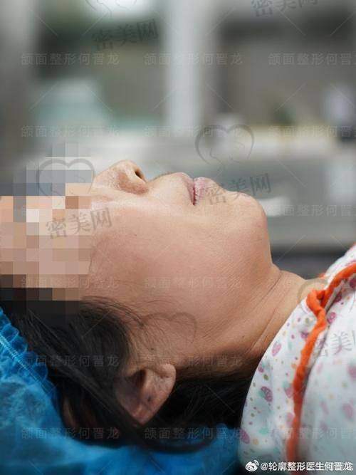 整下巴的风险与注意事项