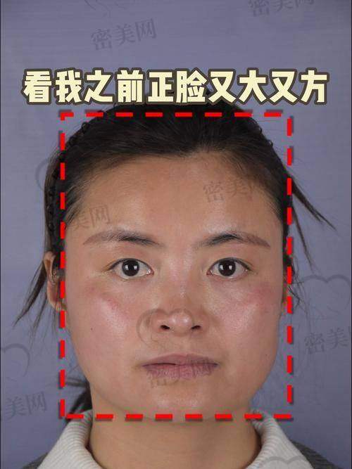 不同地区整下巴价格差异