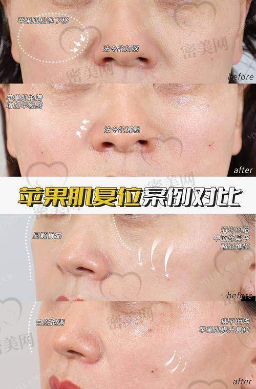 北京华韩虞守辉苹果肌提升：优势特色大揭秘
