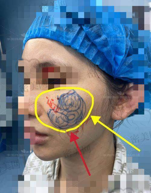 北京华韩虞守辉苹果肌提升：真人实例见证奇迹