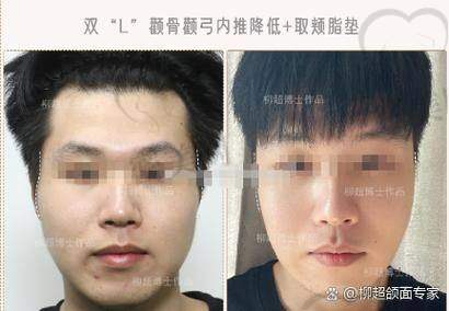 术后成效：惊艳到原地转圈圈