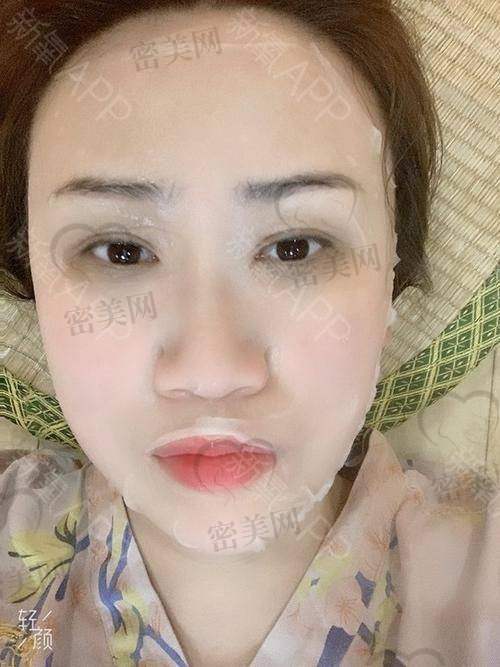 自体脂肪存活时长