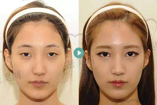 北京米兰柏羽丽都整形医院胡彬美杜莎双眼皮：优势大揭秘