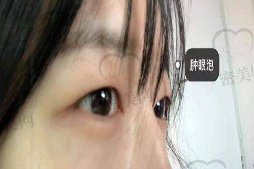 北京米兰柏羽丽都整形医院胡彬：八度美瞳双眼皮真人实例大赏！