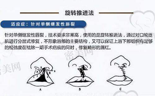 顾陆健医生技术特点：