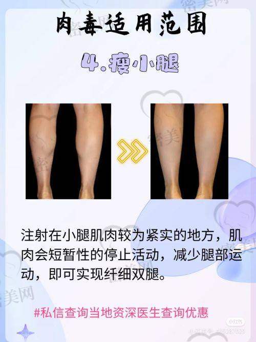 阮凯医生技术特点：