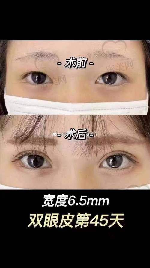 北京米兰柏羽丽都整形医院胡彬美杜莎双眼皮：口碑爆棚