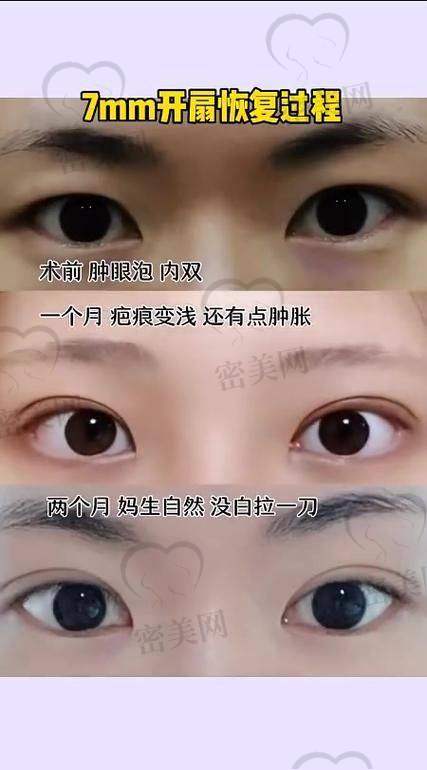 北京米兰柏羽丽都整形医院胡彬美杜莎双眼皮：真人实例见证奇迹