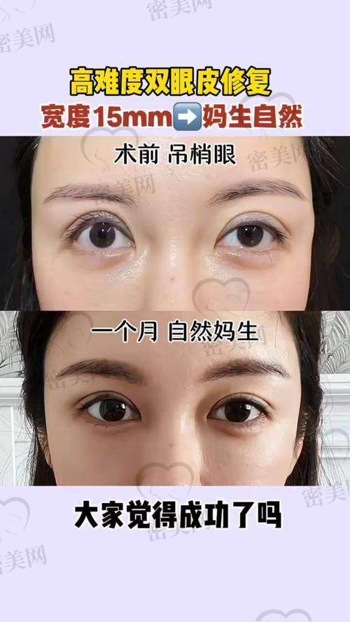 谢立宁医生操刀：普通切开双眼皮的“魔法升级”