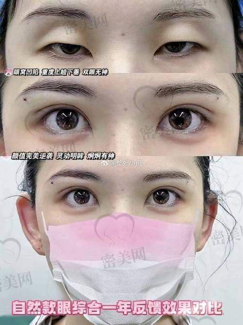 真人实例：金鑫鑫双眼皮的神奇蜕变