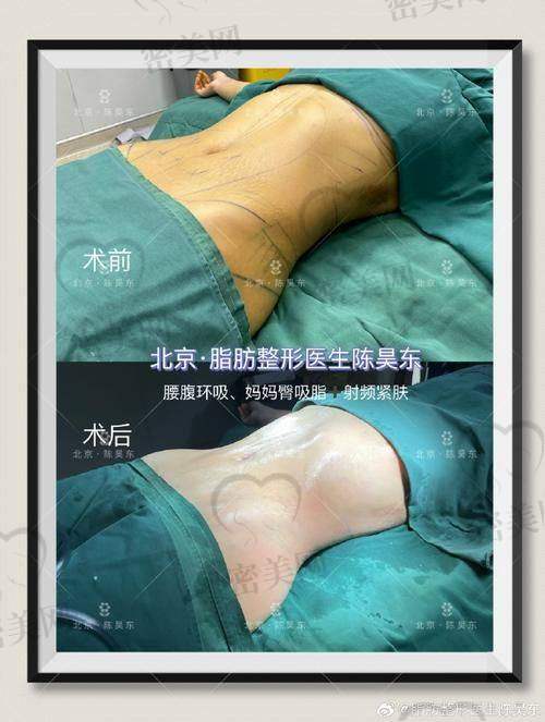 上海何斌吸脂实例大赏