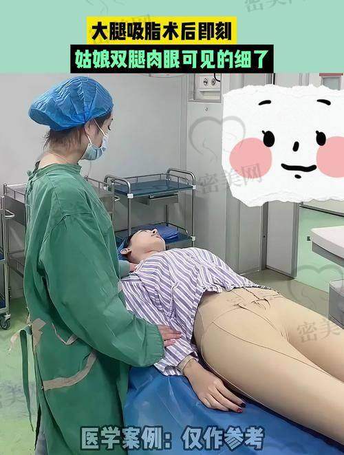 王东医生大腿吸脂为何费用偏高？看看人家用的技术