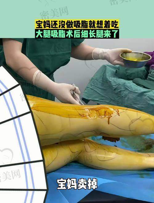 北京艺美王东院长大腿吸脂价格区间及影响因素