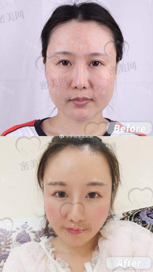 上海李志海下颌角手术成效咋样？小 V 脸不是梦！