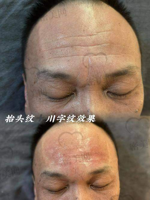手术消除抬头纹，“大招”来袭！