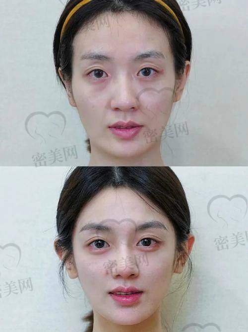 使用润百颜玻尿酸的注意事项“小口诀”