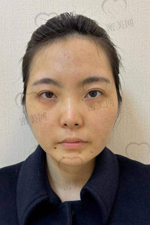 润百颜玻尿酸的副作用“小秘密”