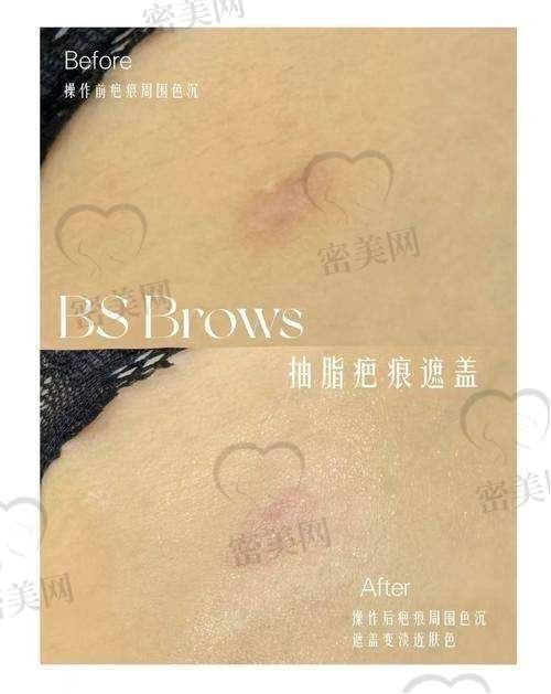 长春花之吻医疗美容门诊部——李娜医生凹陷疤痕修复骨干医生