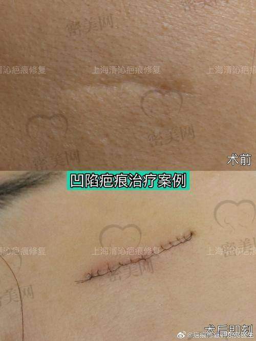 长春中妍奥拉克医学美容医院——张宇医生带你告别疤痕烦恼