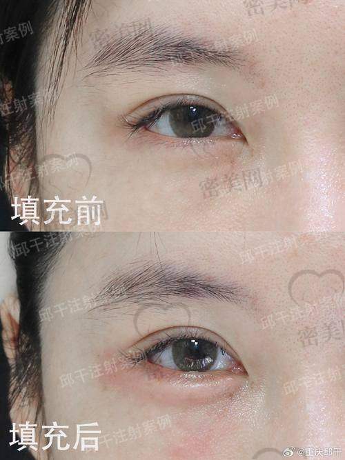 眼窝填充费用大揭秘