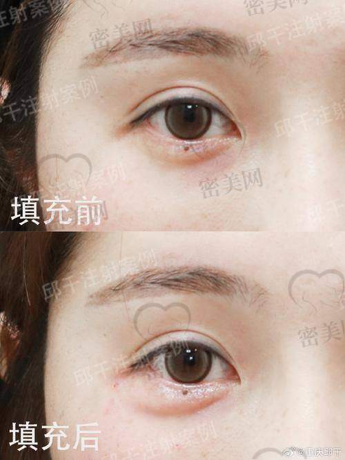 常见的眼窝填充项目