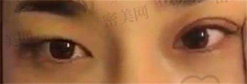 双眼皮收费情况推测