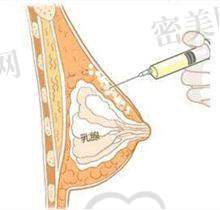 双眼皮项目收费情况