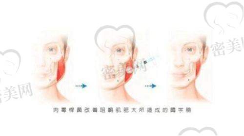深圳地区隆鼻整形项目价格参考